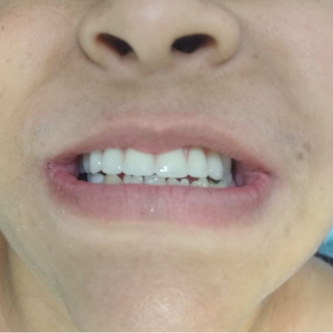 Procedimento realizado pela equipe OdontoCompany Três Corações